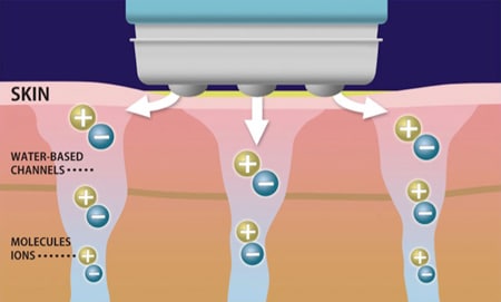 how scalpelectroporation works diagram