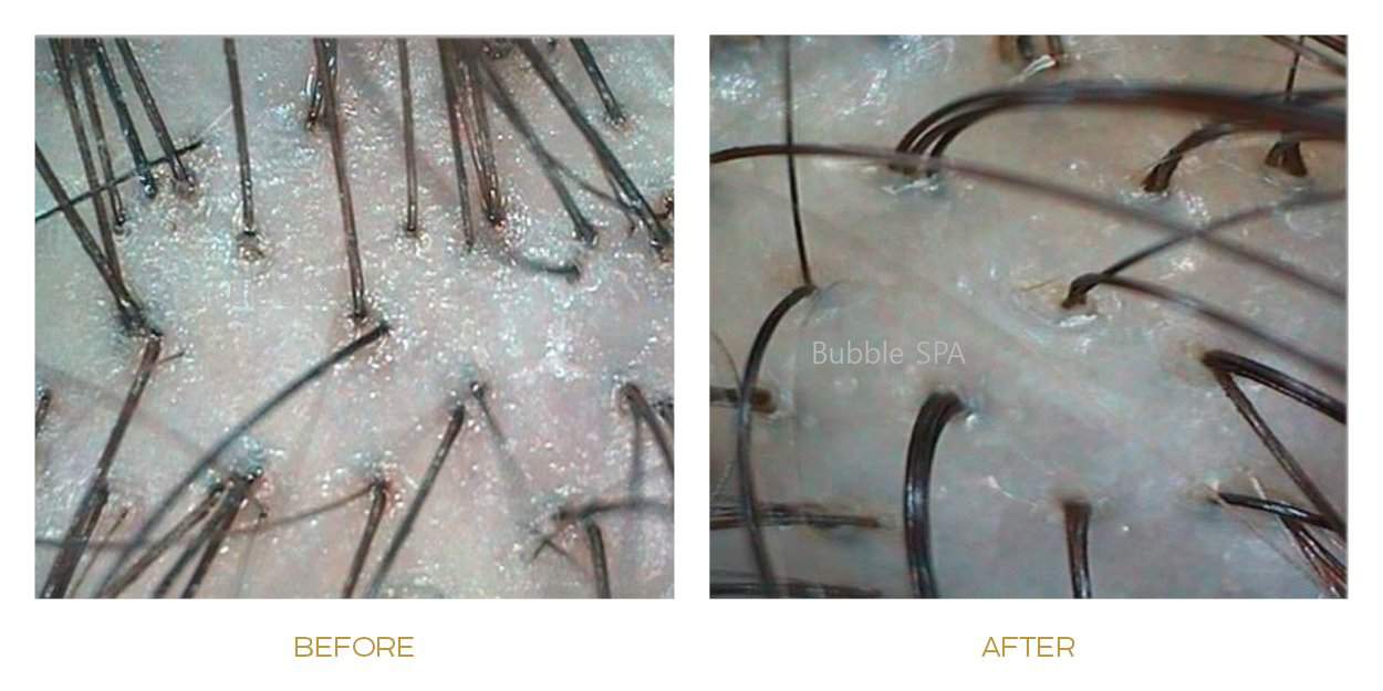 lux lllt before after results