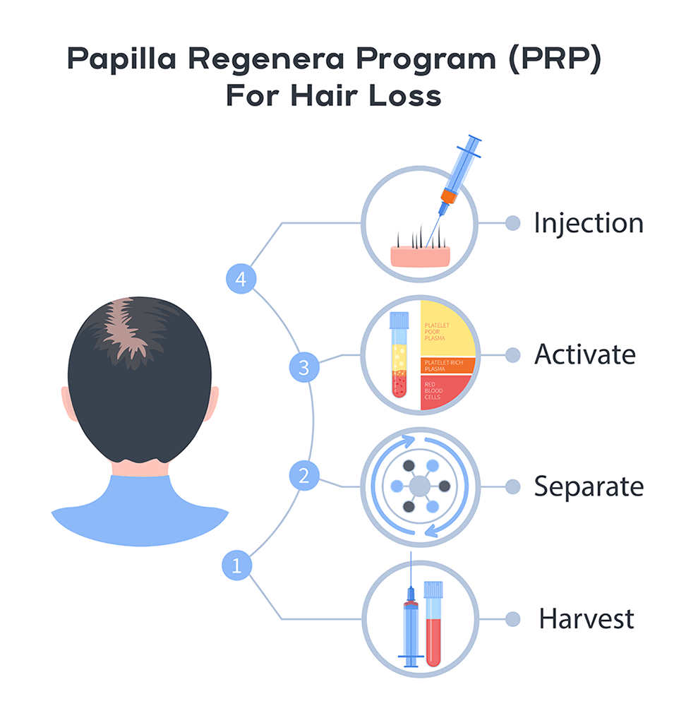 Papilla_PRP_injection