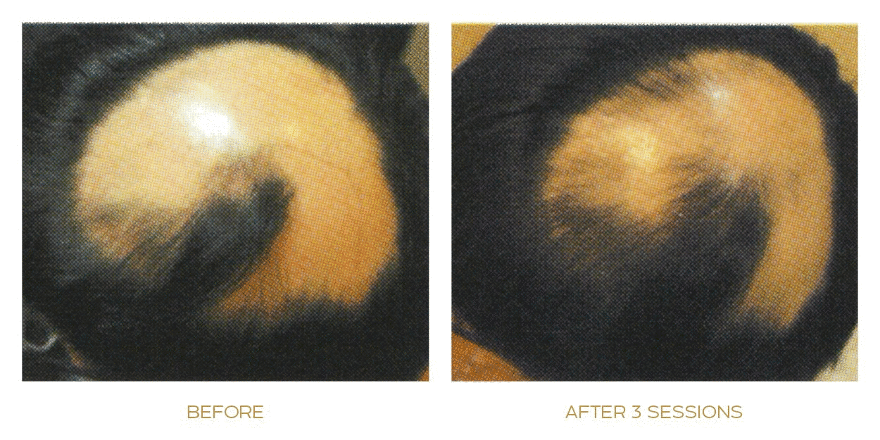 before after hair lost treatment result two male baldness improved