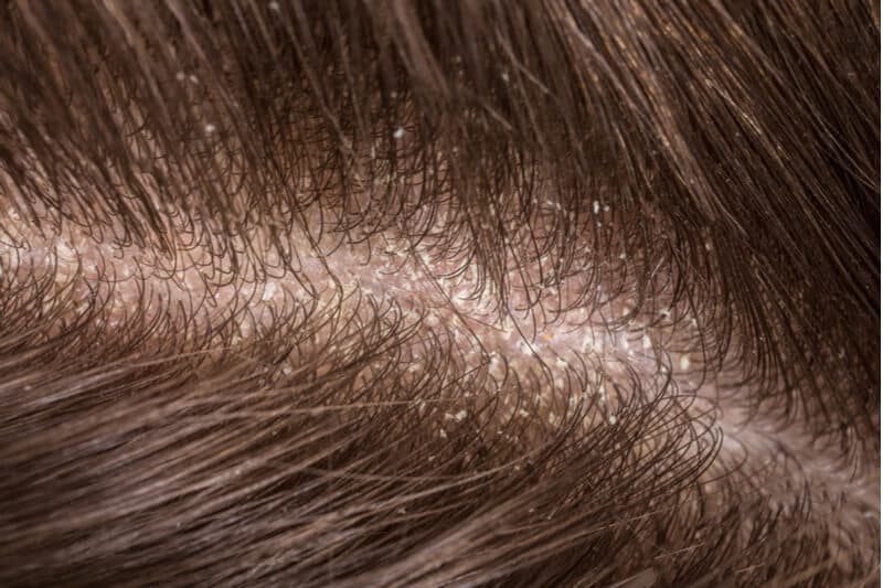 dry scalp dandruff