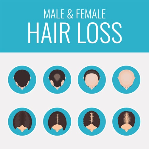 female male hair loss pattern illustration