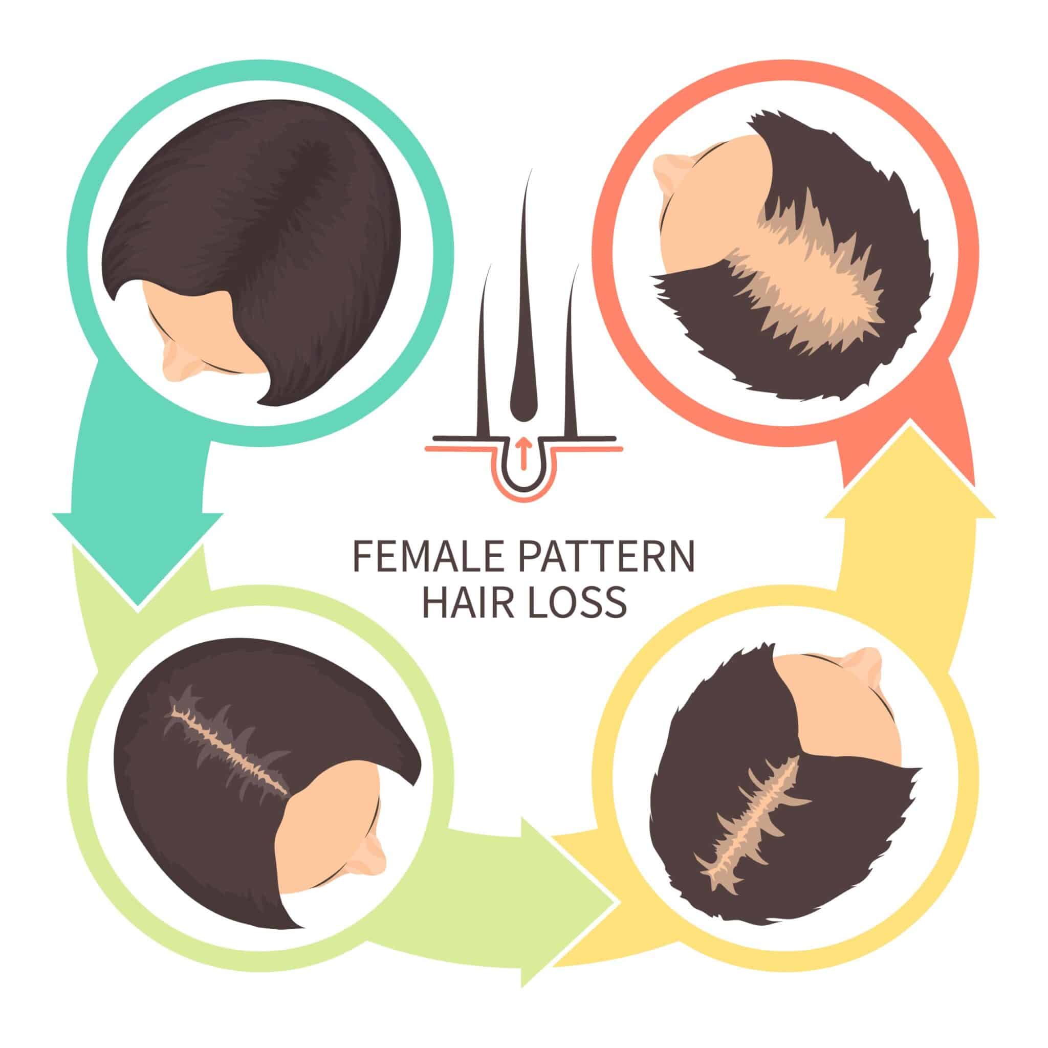 female-pattern-hair-loss