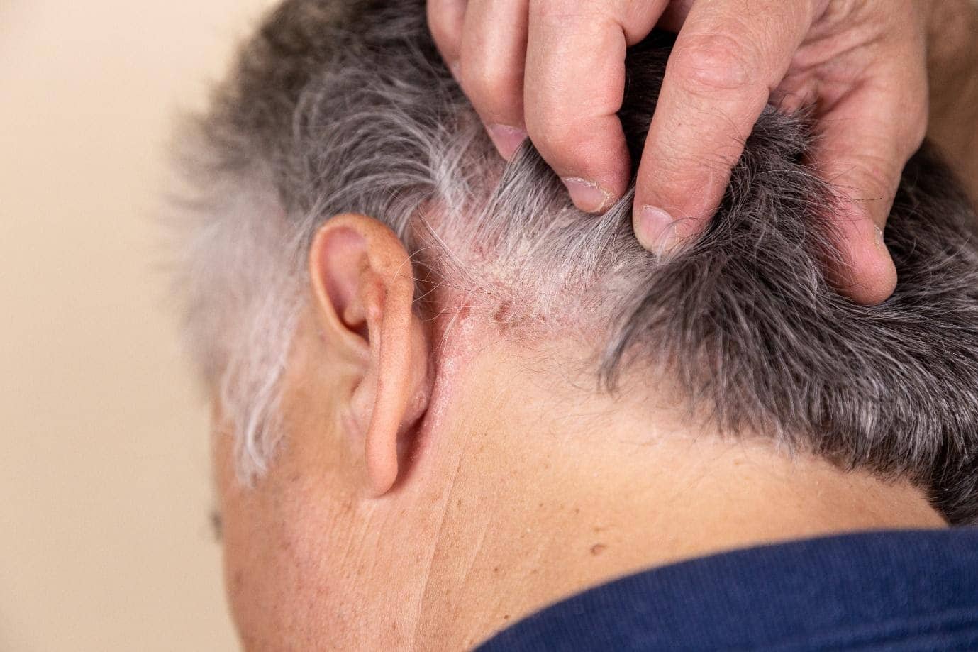 scalp-inflammation