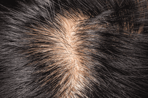 hair loss symptoms - balding hair parting