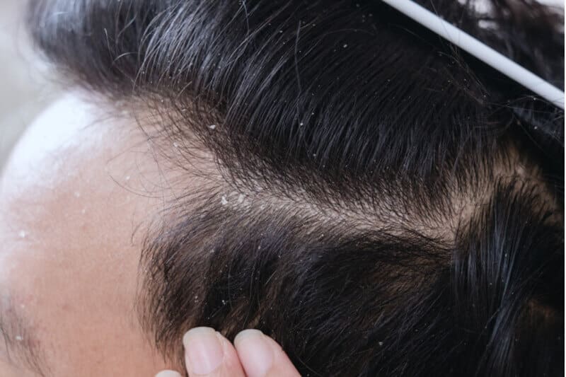 dandruff and hair thinning