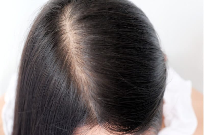 key to healthy scalp