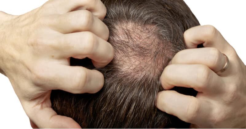 laser hair loss treatment for males