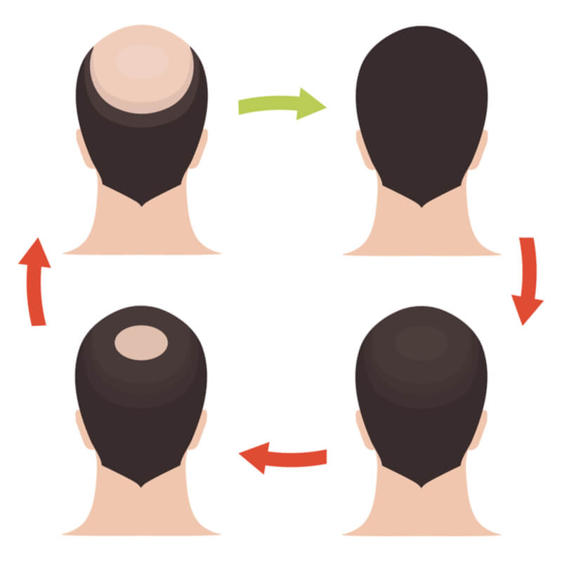 male pattern baldness diagram