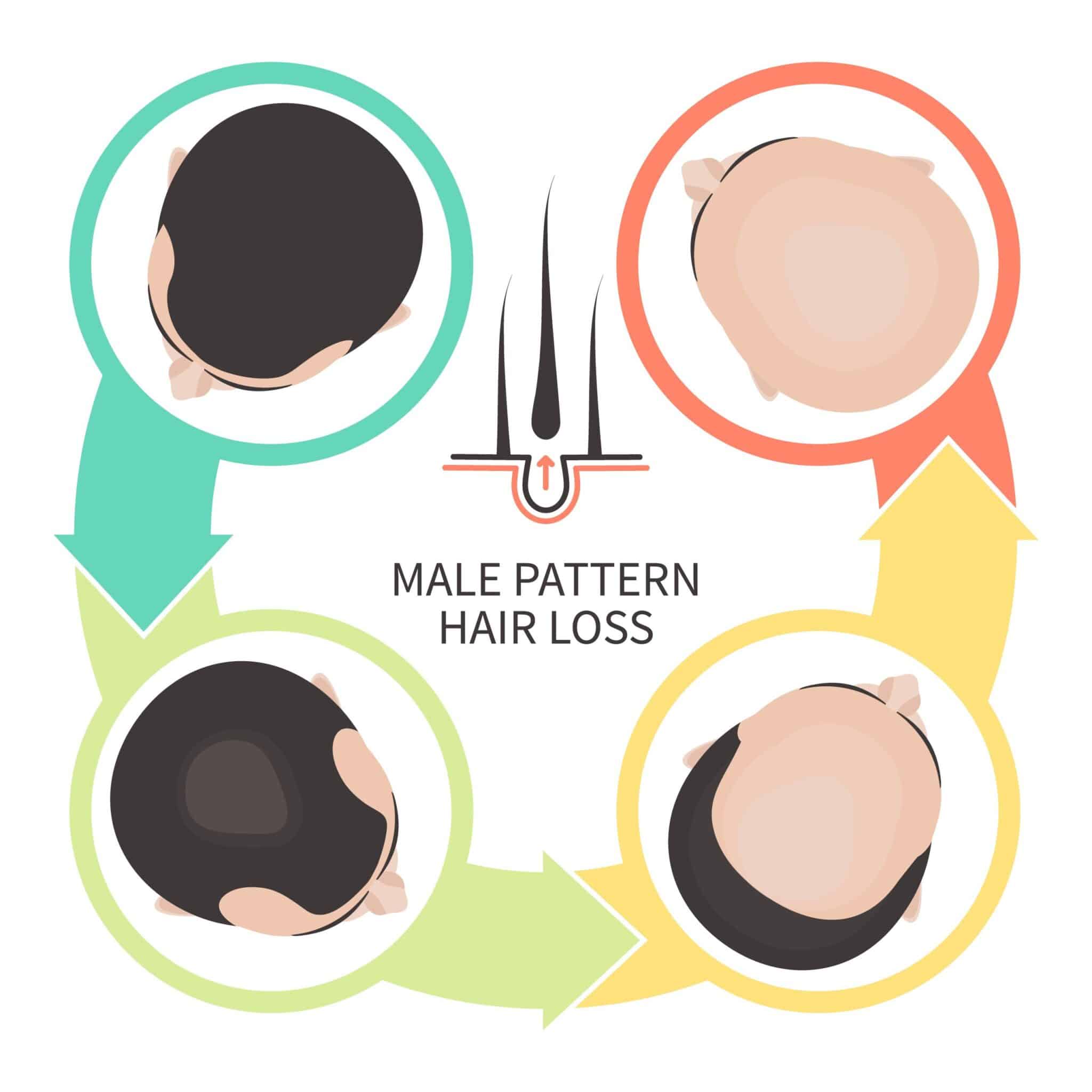 male-pattern-baldness