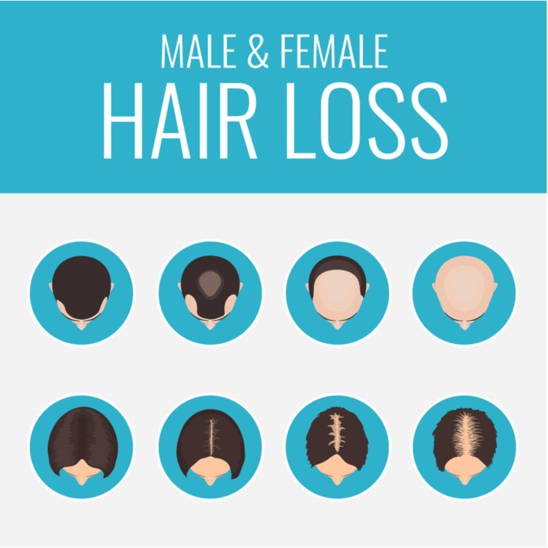 male and female hair loss patterns