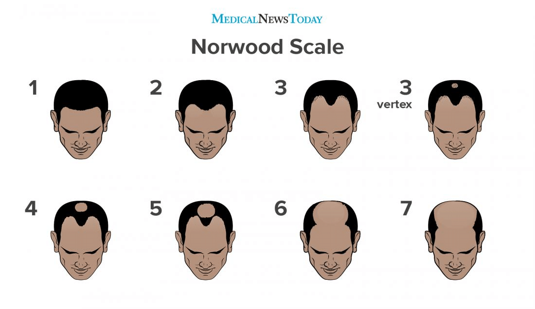 norwood scale male pattern baldness photo