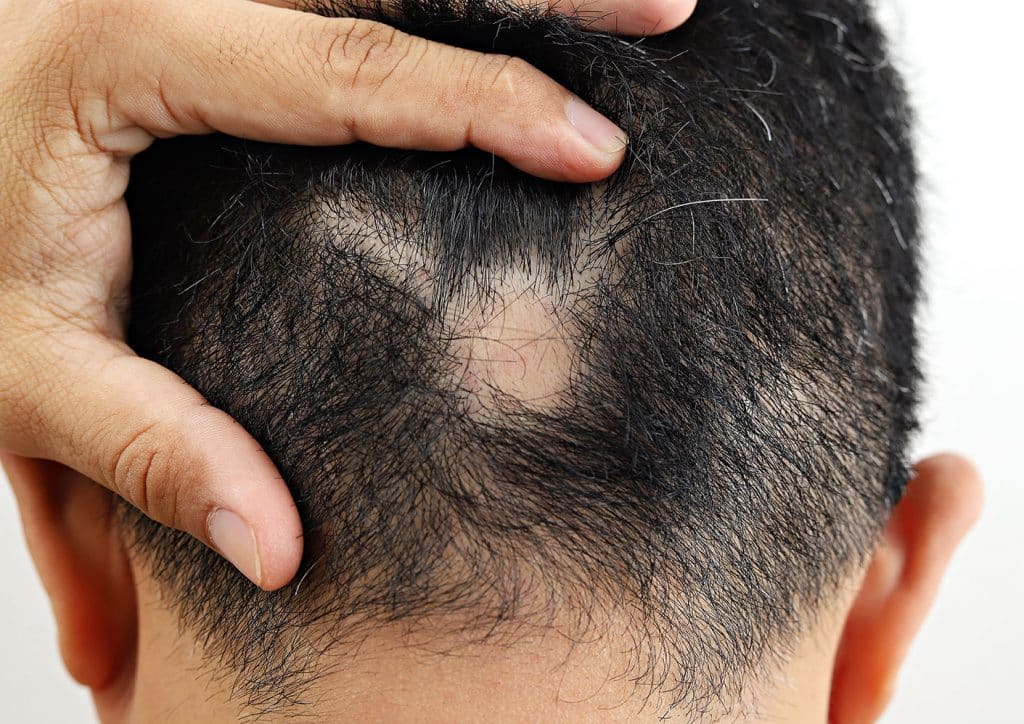 male pattern hair loss