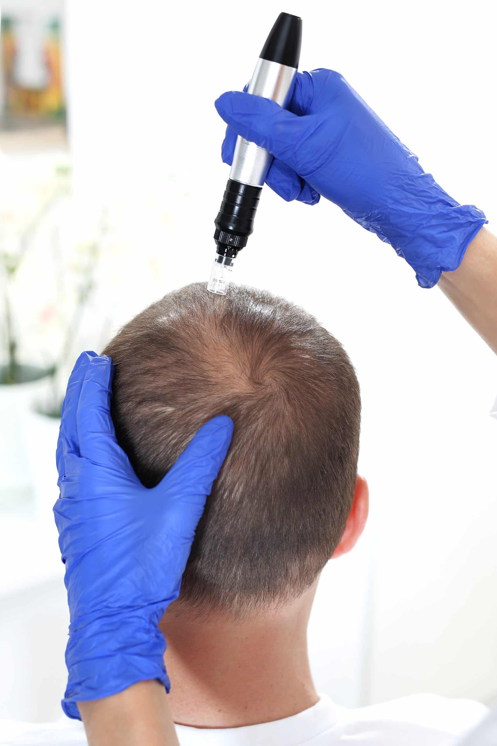 papilla haircare mesotherapy microneedling