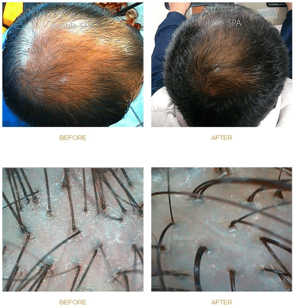 papilla-haircare-sep-treatment-before-after