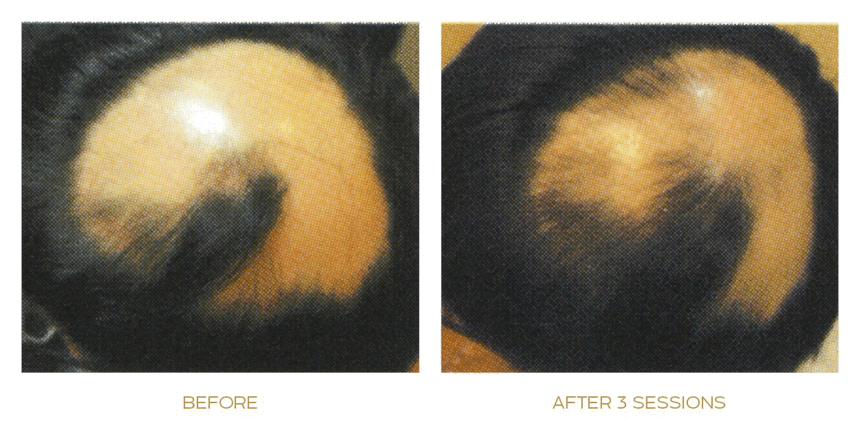 papilla haircare treatment before after real two