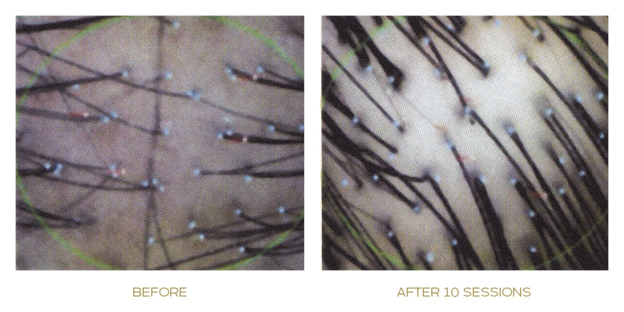 papilla haircare treatment before after real