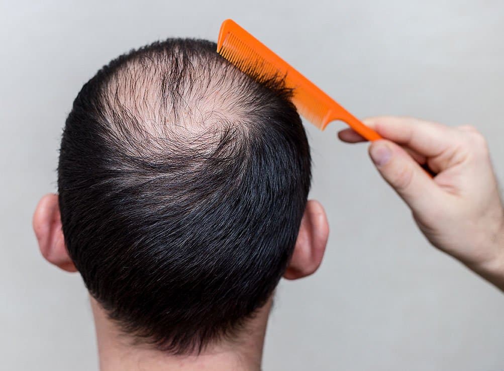genetic vs reactive male hair loss