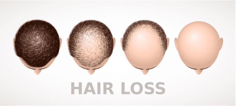 hair loss pattern in men