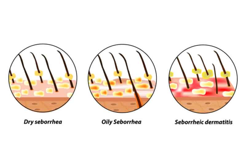 types of scalp problems seborrhea diagram