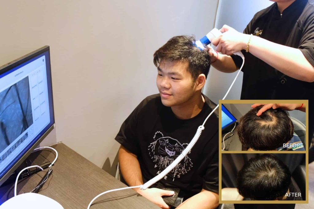 Reverse Balding with Our Hair Loss Treatments